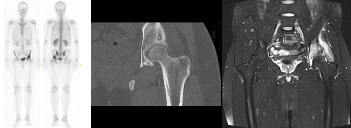Sol Kalça (Asetabulum) Yerleşimli Osteoid Osteoma Nedeniyle Radyofrekans Ablasyon Tedavisi