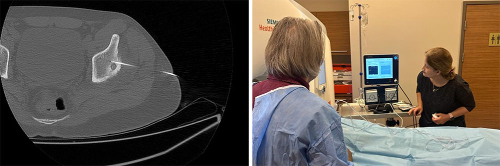 Sol Kalça (Asetabulum) Yerleşimli Osteoid Osteoma Nedeniyle Radyofrekans Ablasyon Tedavisi