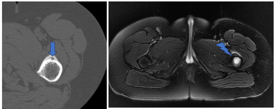 Sol femur osteoid osteoma tomografi ve MR görüntüsü