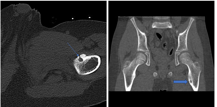 İşlem öncesi tomografi – osteoid osteoma