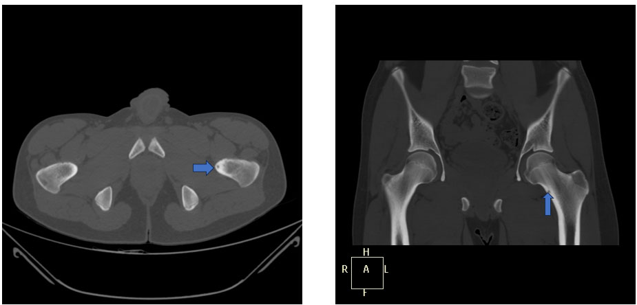 İşlem öncesi tomografi – osteoid osteoma