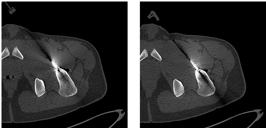 İşlem esnası tomografi – drill ve prob yerleşimi