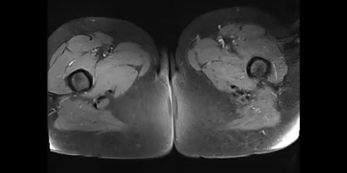 Vaka 7: Lomber,Sakrum ve İliak Kanat Yerleşimli Osteosarkom