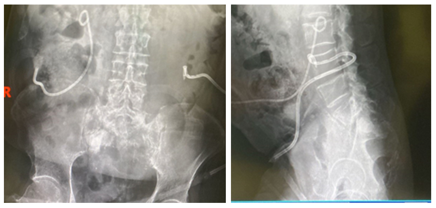 Ameliyat sonrası: Röntgende temizlenen tümör dokusu yerine uygulanan kemik çimentosu görünmekte