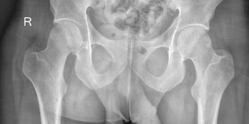Vaka 23: Sakrum Yerleşimli Osteosarkom
